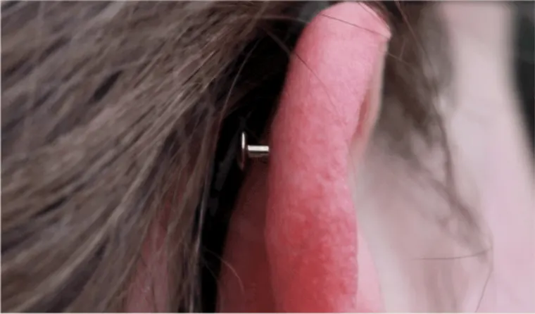 Frisch gesetztes Helix Piercing von hinten mit flachem Stecker